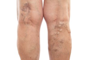 Varicose Veins